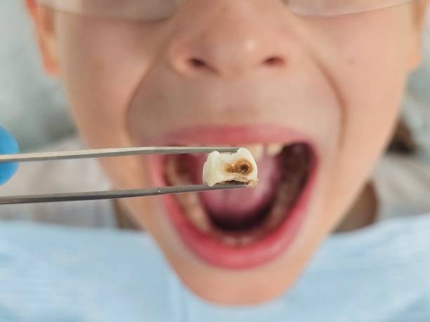 Best Emergency Dentist for Knocked-Out Tooth in Brown Station, MD